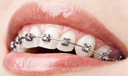 Plastic Braces: Modern and Discreet Orthodontic Solutions