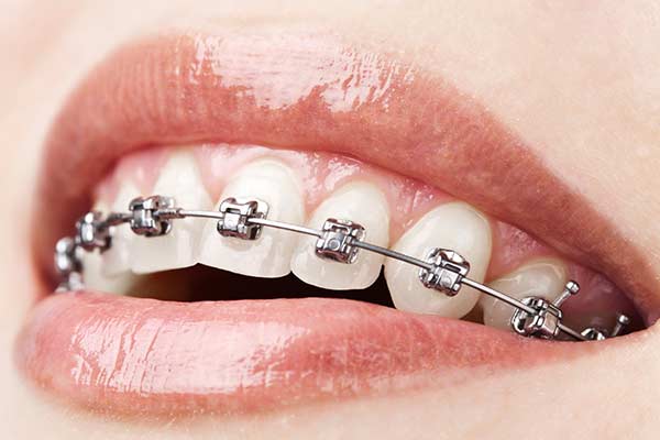 Plastic Braces: Modern and Discreet Orthodontic Solutions