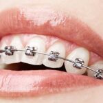 Traditional Braces: Time-Tested Solutions for Your Smile