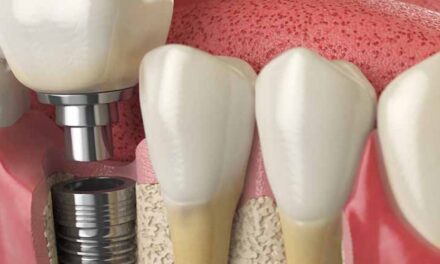 Affordable Dental Implants Cost: Quality Solutions