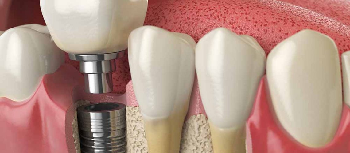 Affordable Dental Implants Cost: Quality Solutions