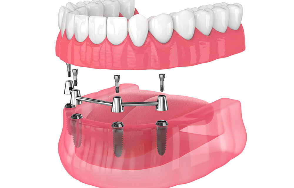 All-on-4 Dental Implants: Comprehensive Solutions for You