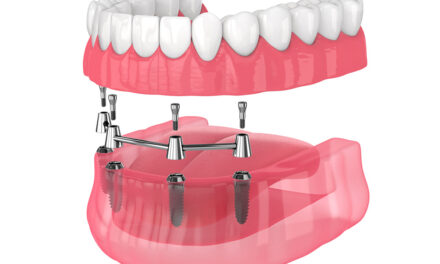 All-on-4 Dental Implants: Comprehensive Solutions for You