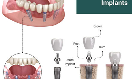 Dental Implants Near Me: Expert Solutions for Your Smile