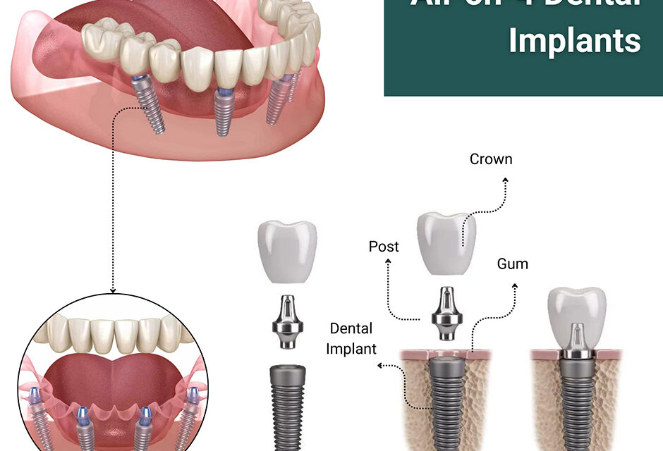 Dental Implants Near Me: Expert Solutions for Your Smile