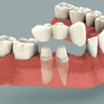 Cantilever Bridge Dental: Innovative Solutions for You