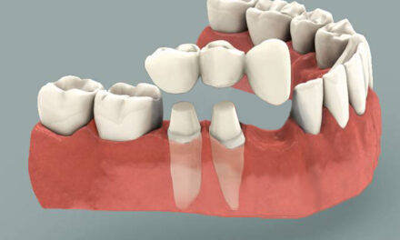 Cantilever Bridge Dental: Innovative Solutions for You