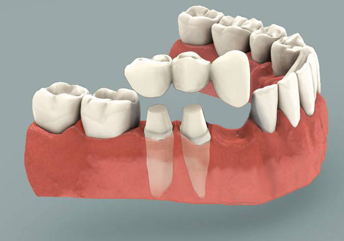 Cantilever Bridge Dental: Innovative Solutions for You