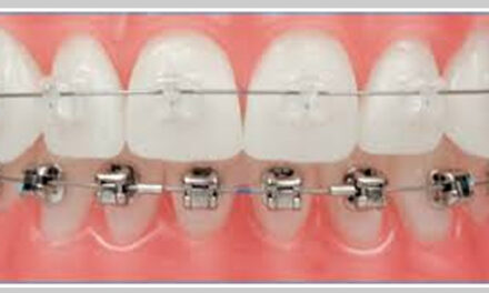 Ceramic Braces: Discreet Orthodontic Elegance for You