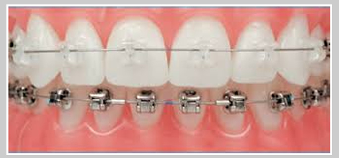 Ceramic Braces: Discreet Orthodontic Elegance for You