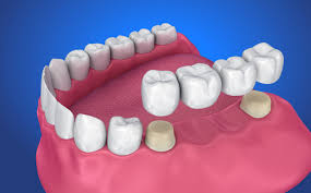 Dental Bridge Cost Guide: Affordable Solutions for You”