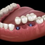 Dental Implant Bridge: Restore Your Smile with Precision