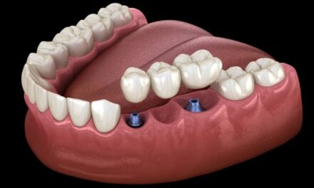 Dental Implant Bridge: Restore Your Smile with Precision