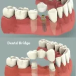 Dental Implant vs Bridge: Choosing Your Best Smile