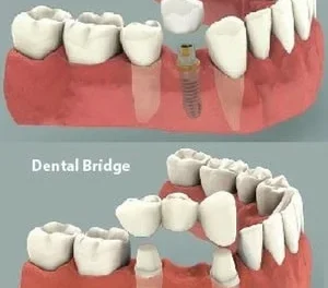 Dental Implant vs Bridge: Choosing Your Best Smile