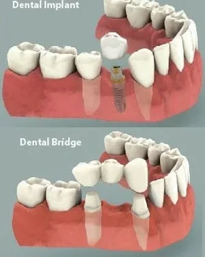 Dental Implant vs Bridge: Choosing Your Best Smile