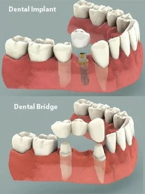 Dental Implant vs Bridge: Choosing Your Best Smile