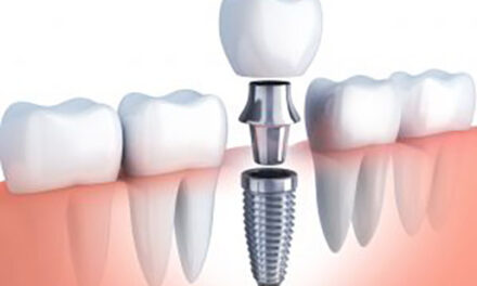 Dental Implants Near Me: Expert Solutions for Your Smile