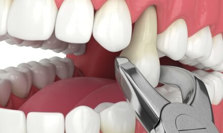 Immediate Relief: Emergency Dental Extraction Services