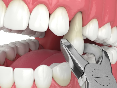 Immediate Relief: Emergency Dental Extraction Services