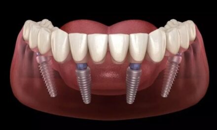 Full Mouth Dental Implants Cost: Affordable Solutions