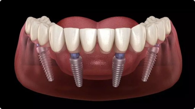 Full Mouth Dental Implants Cost: Affordable Solutions