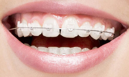 Invisalign Braces: Transform Your Smile with Confidence