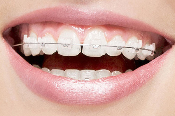 Invisalign Braces: Transform Your Smile with Confidence