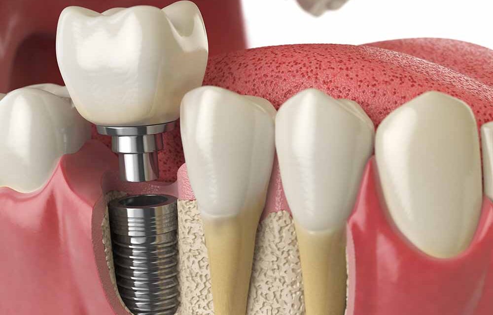 Low-Cost Dental Implants: Affordable Solutions for You