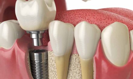 Low-Cost Dental Implants: Affordable Solutions for You