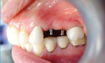 Mini Dental Implants: Compact Solutions for Your Smile