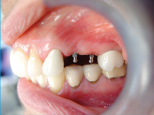 Mini Dental Implants: Compact Solutions for Your Smile